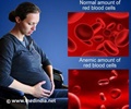 妊娠期贫血