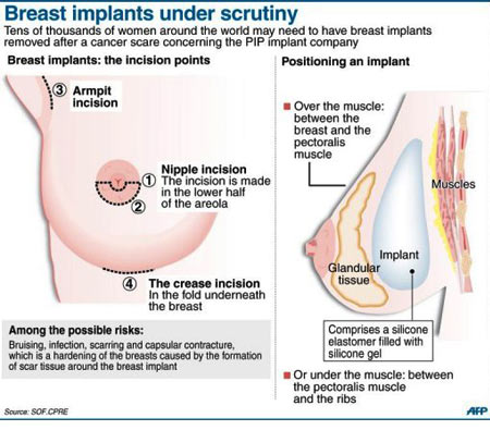 乳房植入物遭质疑